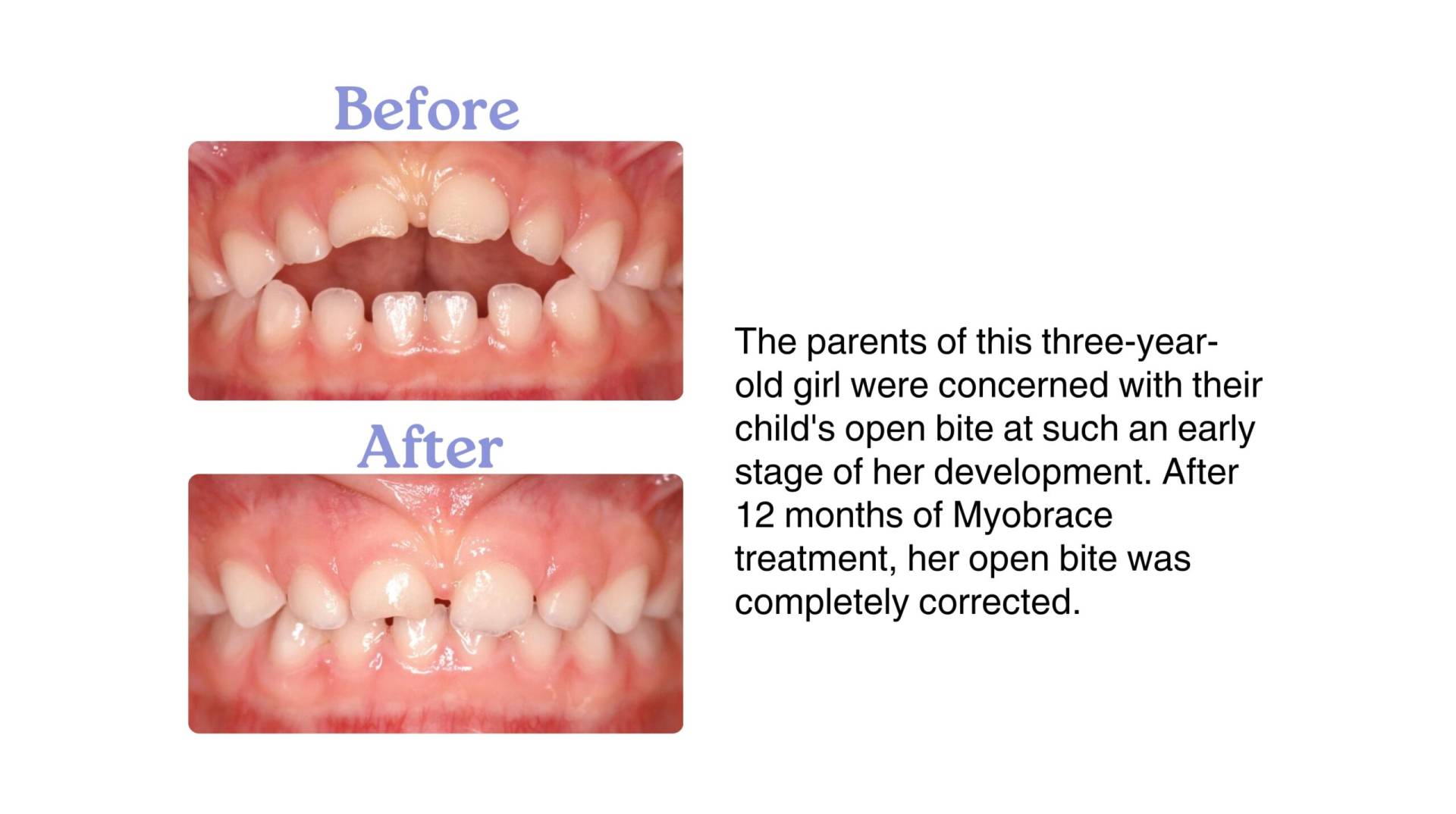 <img src="myobrace-before-after.jpg" alt="Before and after Myobrace treatment for child in Delhi" />
<img src="tmj-treatment-delhi.jpg" alt="TMJ jaw therapy using myofunctional techniques" />

