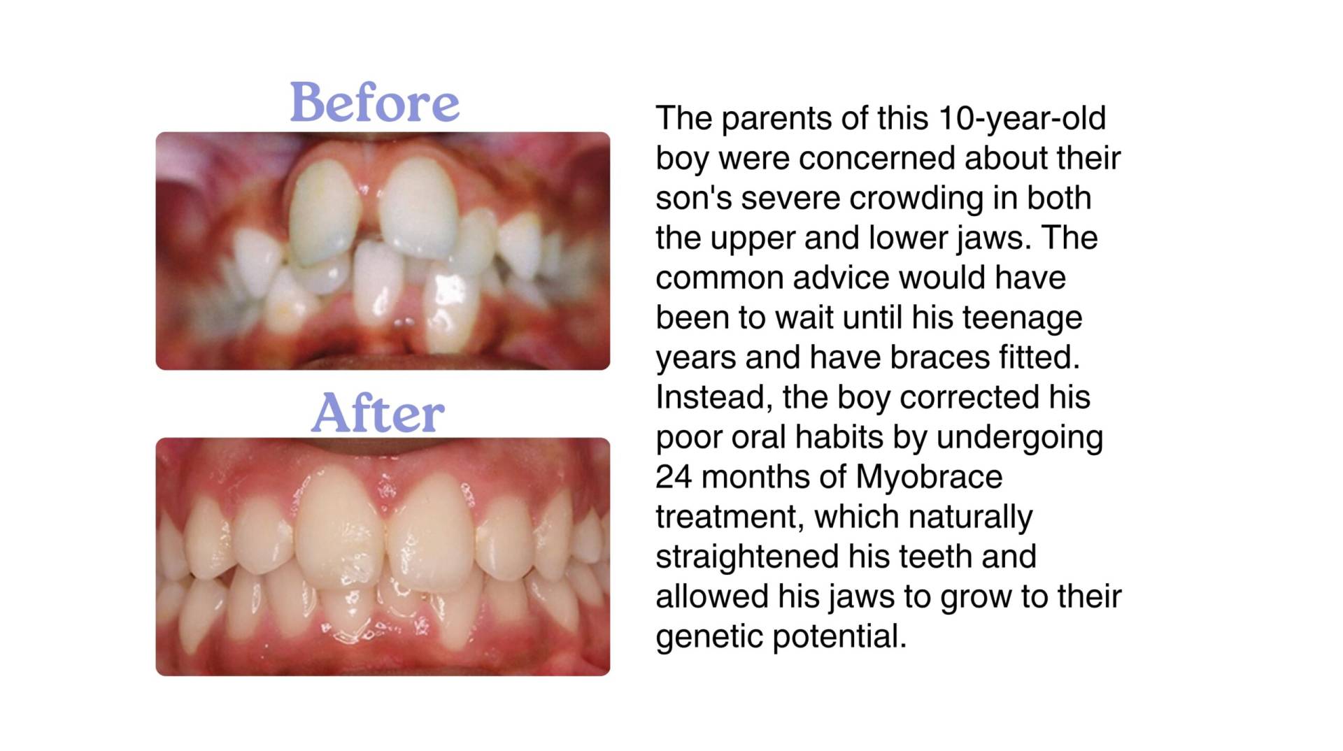 <img src="myobrace-before-after.jpg" alt="Before and after Myobrace treatment for child in Delhi" />
<img src="tmj-treatment-delhi.jpg" alt="TMJ jaw therapy using myofunctional techniques" />
