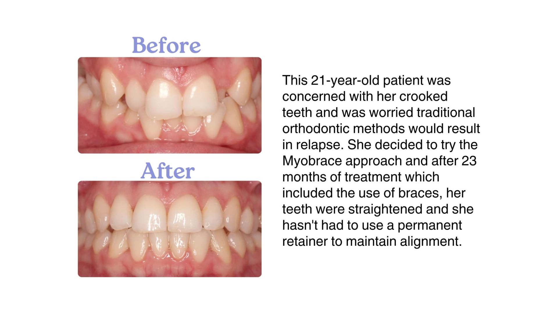 <img src="myobrace-before-after.jpg" alt="Before and after Myobrace treatment for child in Delhi" />
<img src="tmj-treatment-delhi.jpg" alt="TMJ jaw therapy using myofunctional techniques" />
