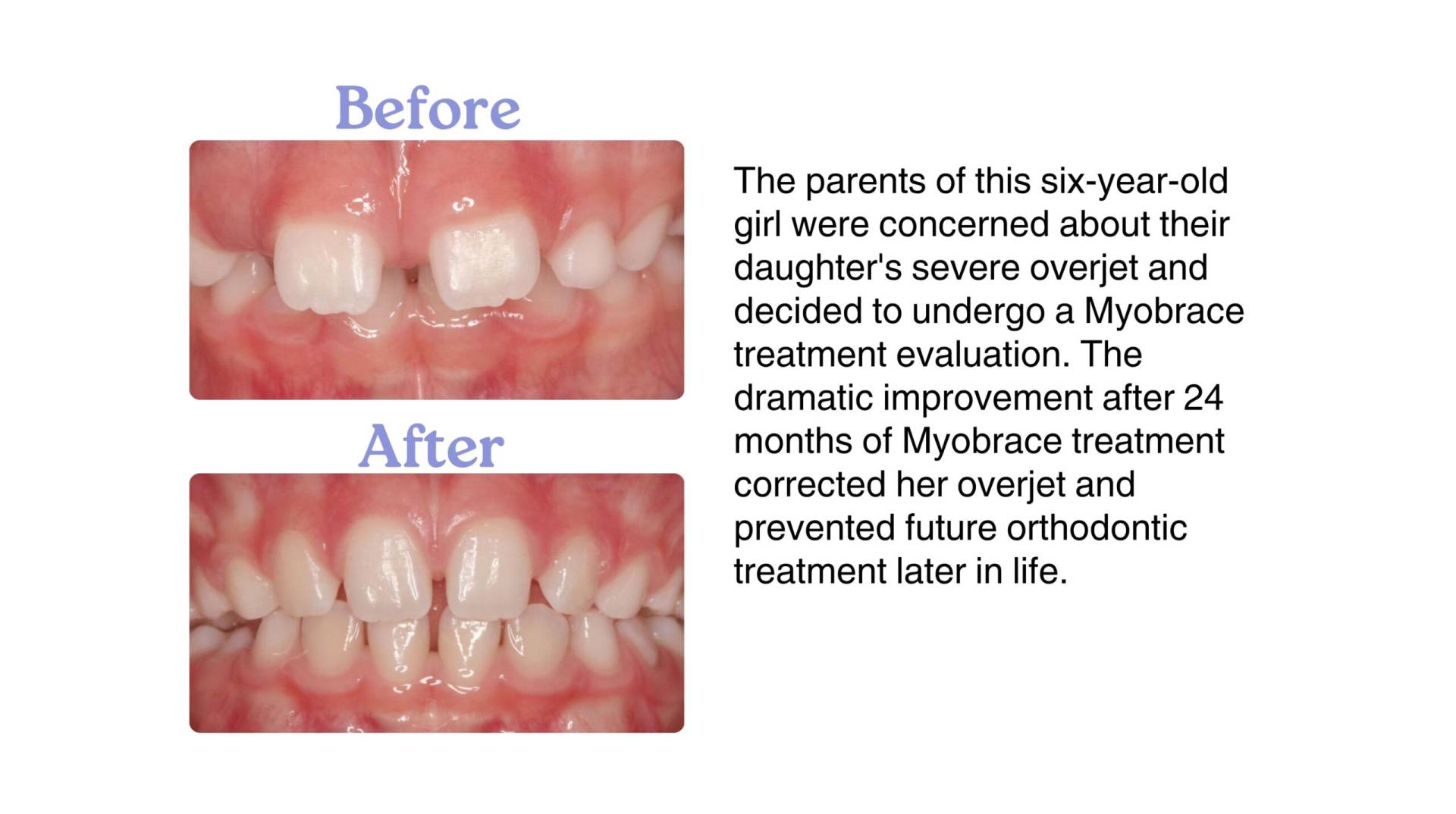 <img src="myobrace-before-after.jpg" alt="Before and after Myobrace treatment for child in Delhi" />
<img src="tmj-treatment-delhi.jpg" alt="TMJ jaw therapy using myofunctional techniques" />
