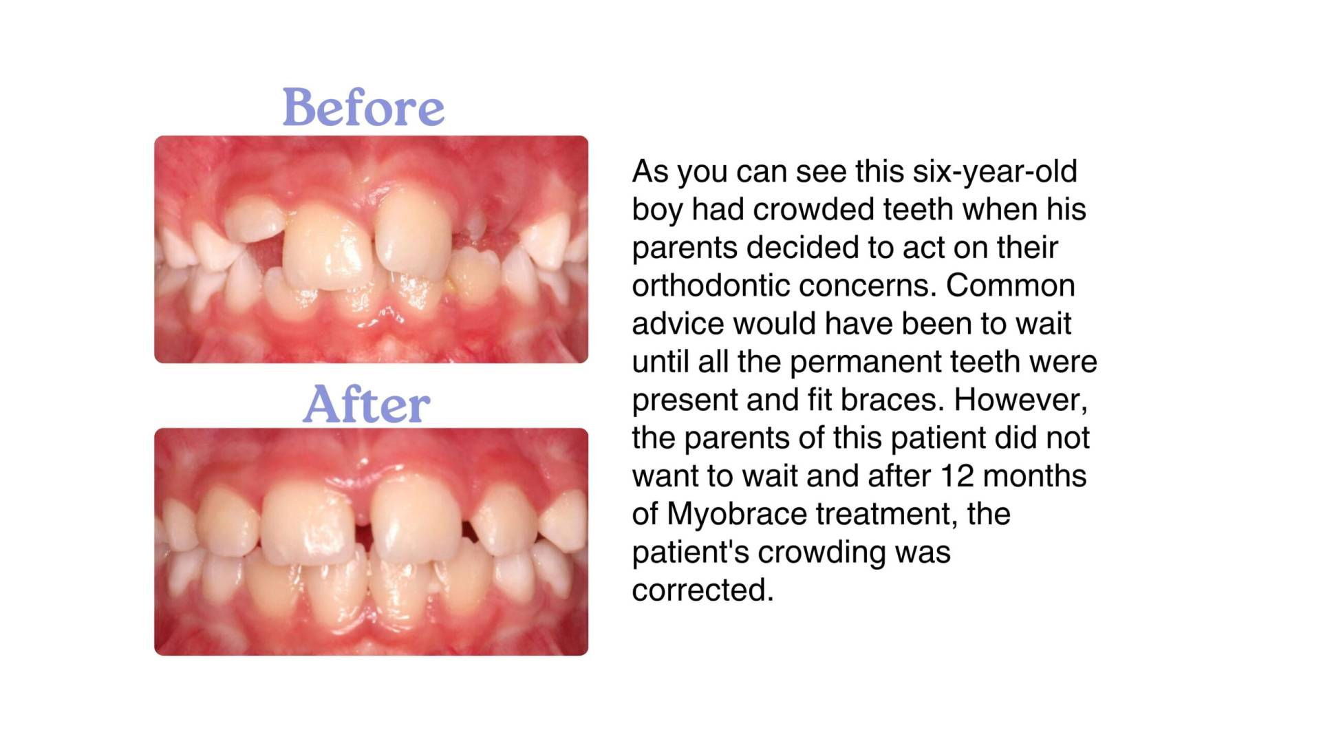 <img src="myobrace-before-after.jpg" alt="Before and after Myobrace treatment for child in Delhi" />
<img src="tmj-treatment-delhi.jpg" alt="TMJ jaw therapy using myofunctional techniques" />
